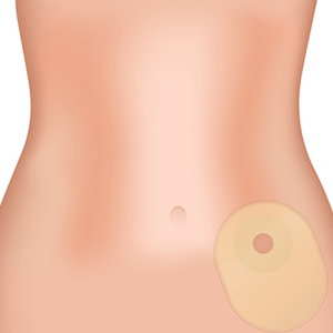 stoma