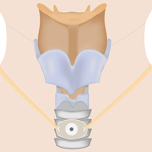 tracheostoma